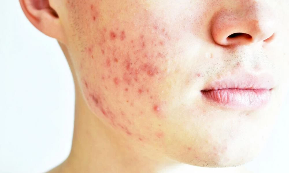 Ακμή: Ποιες είναι οι τροφές που την προκαλούν και τι να προσέξετε